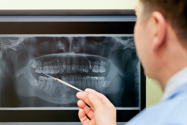 Signs You Need A Bone Graft