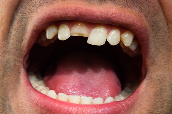 How Important Is It To Get Dental Care For A Chipped Tooth?