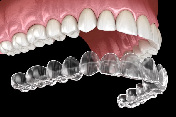 Clear Aligner Teeth Straightening Treatment From Your Family Dentist