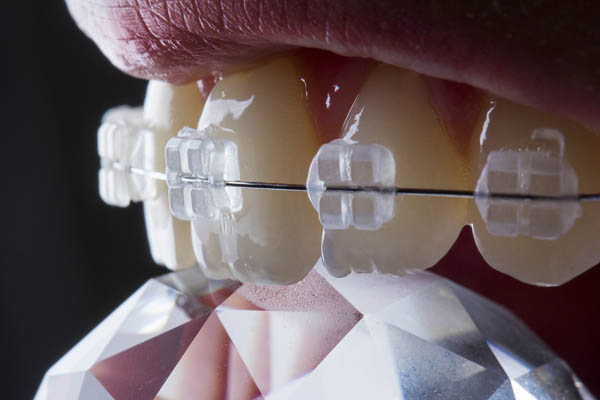 Common Clear Braces Maintenance And Aftercare