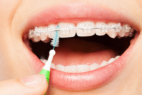 Why You Should Consider Clear Braces