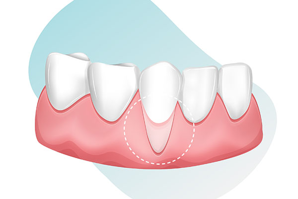 Common Causes Of Receding Gums