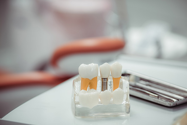 When Would You Need Dental Implants?