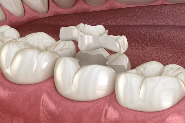 How Soon Can I Eat After Getting A Dental Inlay?