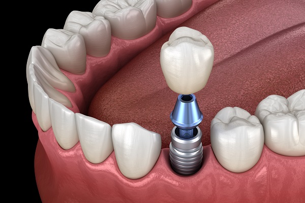 Advice For Implant Crown Aftercare
