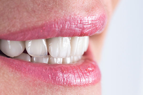 How To Prevent Cavities Under Veneers from New York Dental Office in New York, NY