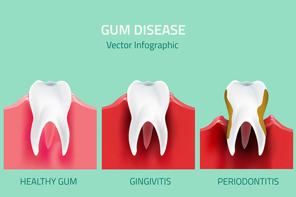 Preventative Dental Care Against Gum Disease