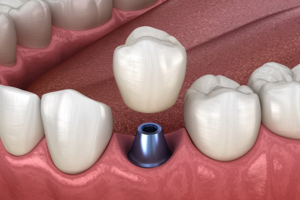 Signs You Might Need Prosthodontics