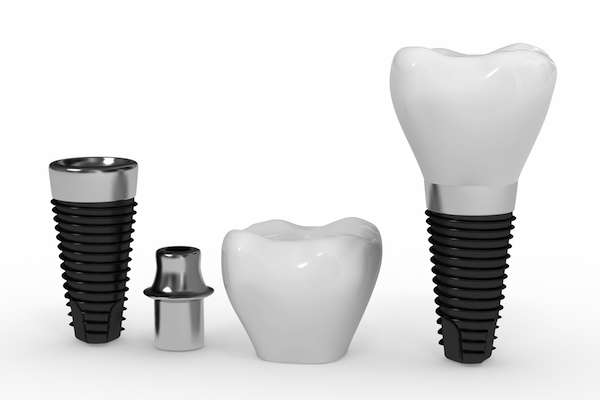 What Are the Parts of Dental Implants from New York Dental Office in New York, NY